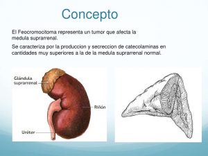 Concepto de feocromocitoma