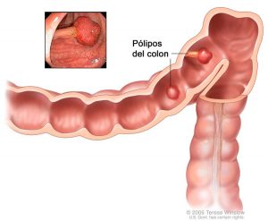 Imagen de pólipos en el colon