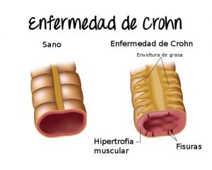 Gráfico de la enfermedad de Crohn