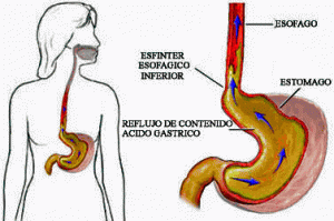 El esfínter esofágico inferior