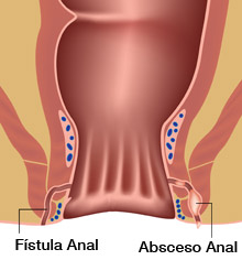 La fístula anal y el absceso anal