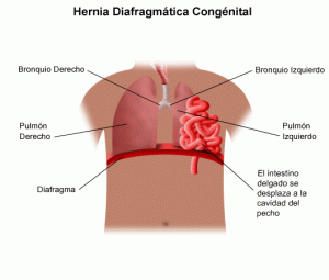 Hernia diafragmática, en este caso congénita
