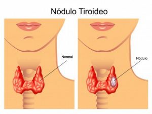 nodulo-tiroideo