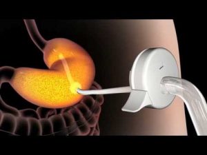 Imagen de la válvula que controla el acceso al bypass del estómago