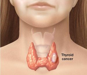 Localización del cáncer de tiroides
