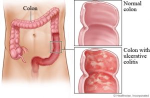 Úlcera en el colon