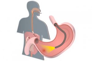 La endoscopia nos ayuda a detectar las úlceras