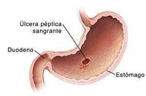Úlcera péptica 