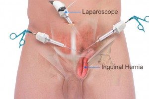 laparoscopia-cirugia-de-las-hernias