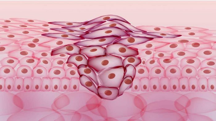 Qué es neoplasia - IOCir